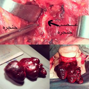 جراحى_تیروئید
